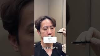 피부재생의 끝판왕! 줄기세포를 받았습니다! 모공, 잔주름, 화이트닝, 보습 전부 다 개선되는 유일한 시술입니다 :) 후기는 한달뒤!