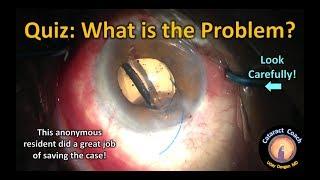 Cataract Surgery Quiz: Can you spot the problem that needs to be addressed?