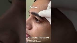 Fox Eyes Surgery | Before And 5 Days After