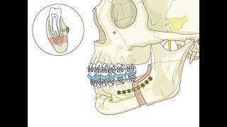 Bilateral Sagittal Split Ramus Osteotomy, SSRO 하악수술