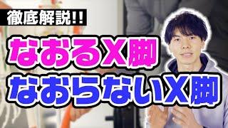 【X脚矯正】治るX脚、治らないX脚を誰でも簡単に見分ける方法