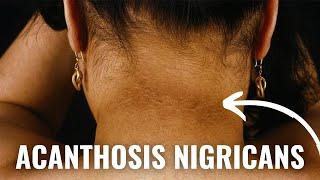 How To Get Rid of Acanthosis Nigricans - Dark Armpits, Groin and Neck