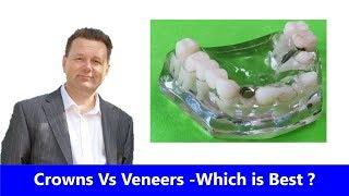 Crowns Vs Veneers - Which is best?