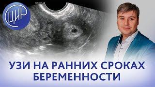 УЗИ на ранних сроках. Задачи врача ультразвуковой диагностики на ранних сроках беременности.