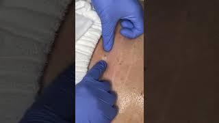 Blackhead removal on client lower back