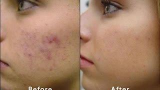 Updated Microdermabrasion | MaenaS Before & After Acne Scars Blackheads PMD Facial routine massage