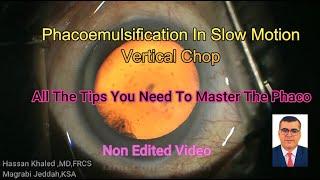 Phacoemulsification In Slow Motion ,Tips You Need To Master Phaco