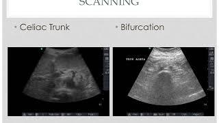 UH CMC ED Ultrasound Cases: #2 AAA