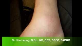 Dr Kin Leung Naturopathic Case Review Patient Gout Noticeable swelling Right ankle Inflamed