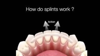 How Do Dental Splints Work