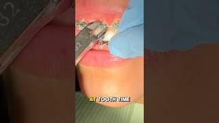 How does it feel after getting your braces off ⁉️ Braces off after 25 months Toothtime New Braunfels