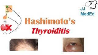 Hashimoto’s thyroiditis: What Is It, Who's At Risk and What You NEED to Know