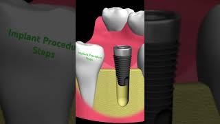 Steps of a Dental Implant #dentist #implantdentist