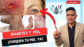 9 SIGNOS DE ALARMA EN LA PIEL QUE INDICAN DIABETES MELLITUS