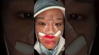 #코수술 후기 과정 6개월 지난 지금