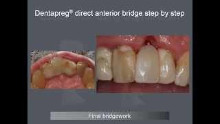 Composite Anterior Bridge with Dentapreg by Dr. Eric Van Zytveld