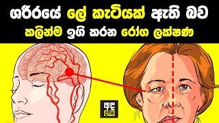 ශරීරයේ ලේ කැටියක් තියෙනකොට මෙන්න මේ ලක්ෂණ ඇති වෙන්න පටන් ගන්නවා | Blood Stroke Signs in Your Body