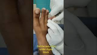 Toe Dislocation Emergency reduction | Toe injuries treatment | Adamya Hosp Videos