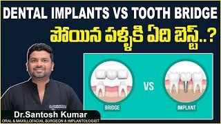 పోయిన పళ్ళకి బెస్ట్ ఆప్షన్ || Dental Implant vs Tooth Bridge in Telugu || Eledent Dental Hospitals