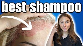 *BEST* Shampoo For Psoriasis | Dermatologist Recommended