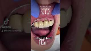 Dancing teeth! Loose teeth , Infected teeth with mobility