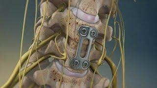 Spine Surgery (Anterior Cervical Discectomy and Fixation - ACDF) - Post fixation stability