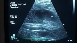 Uterine rupture at the site of a previous cesarean scar after normal delivery