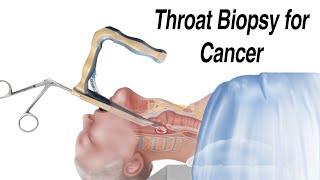 How a Throat Biopsy is Performed to Check for Throat Cancer