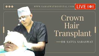  Live Crown Hair Transplant Procedure Video in detail. #hairtransplant
