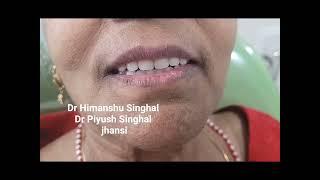 fixed teeth in 72hours with dental implant,no pain,no swelling ,no bleeding.....