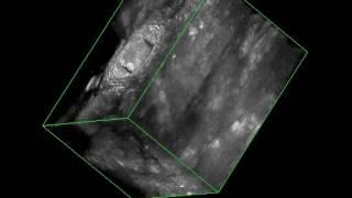 Three dimensional intrastomal ultrasonography