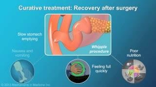 Pancreatic Cancer: Treatment and Outcomes