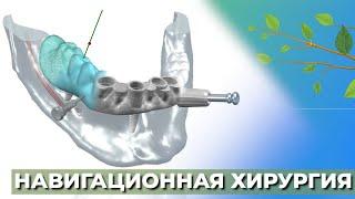 Навигационная хирургия️