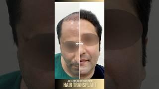 Hair Transplant for Natural, Fuller Hair | Dr. Adarsh Tripathi #hairtransplant