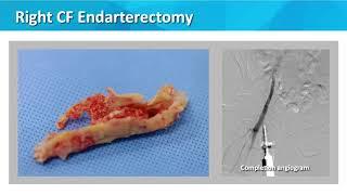 A Case of Hybrid approach to multilevel CLI - Eric Scott, MD