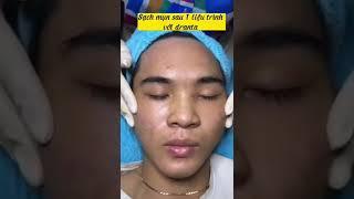 Sạch mụn sau 1liệu trình #trùm trị mụn Huỳnh Phương #antaski #dranta #nanmun