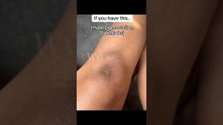 If you have this.. Use that️#darkmarks #hyperpigmentation | Whippedwonderlandskincare