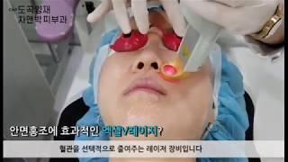 얼굴홍조치료, 차앤박피부과 엑셀V로 빠르게!