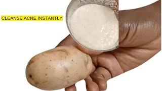 Unbelievable! Use this acne cleanser to get a flawless spotless skin