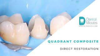 Quadrant composite direct restoration