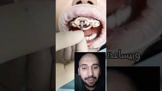 زراعة الأسنان بسهولة عن طريق الدليل الجراحي #abudhabi #dentist #implant