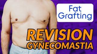 Revision Gynecomastia Surgery: Correcting a Botched Chest (Fat Grafting & Fat Flap)