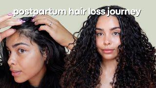 Postpartum hair loss journey + what I'm using to re-grow my hair line!