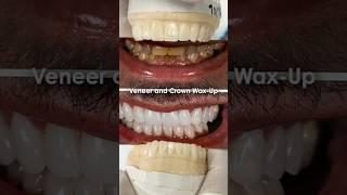 Veneer and Crown Wax-Up #lsk121shorts #dentist #teeth