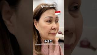 안면거상+목거상+하안검수술 후기 #shorts