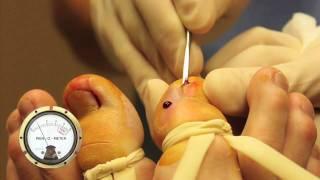 Ingrown Toenail Surgery- WARNING GROSS with Pain-O-Meter