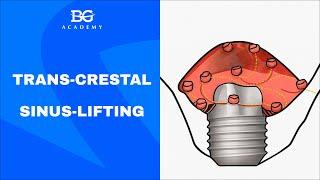 Trans-crestal sinus-lifting
