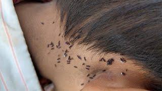 Take out all hundred lice from hair - Remove lice from short hair