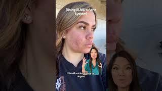 I love seeing real results from real people using my SLMD Acne System! ️