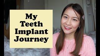 Revealing My Little Secret / Teeth Implants in the UK